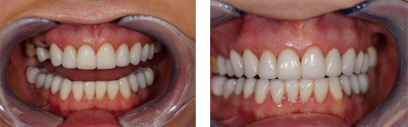 Before and After Implant Restoration